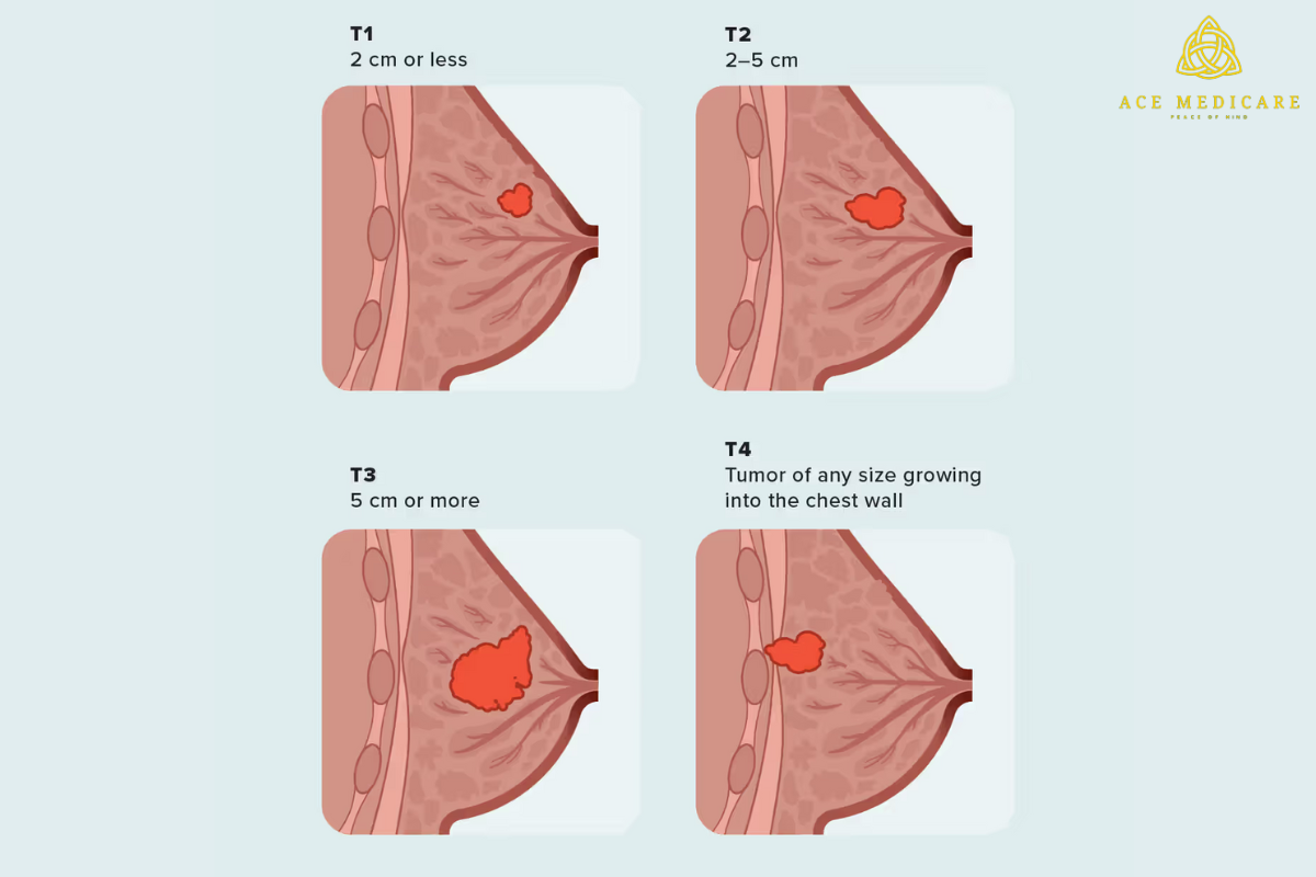 Exploring Different Types of Breast Lumps: What You Need to Know